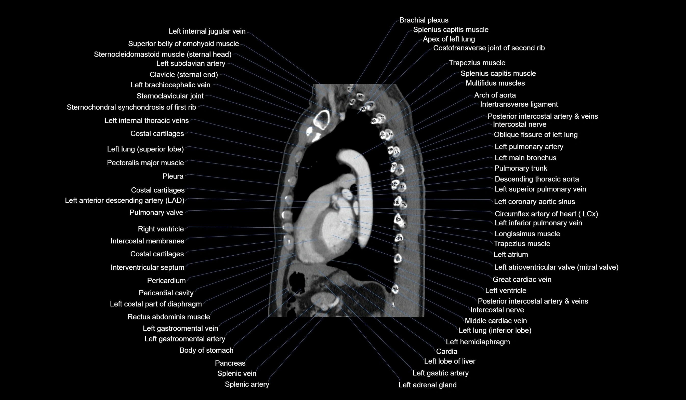 CT chest (thorax) soft tissue window labelled sagittal cross sectional anatomy radiology image-00085.webp